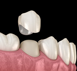 A 3D illustration of a dental crown being placed