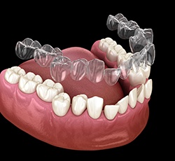 a 3D illustration showing Invisalign being placed on crooked teeth