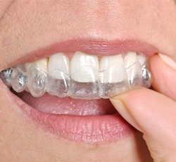 Delta dental braces cost