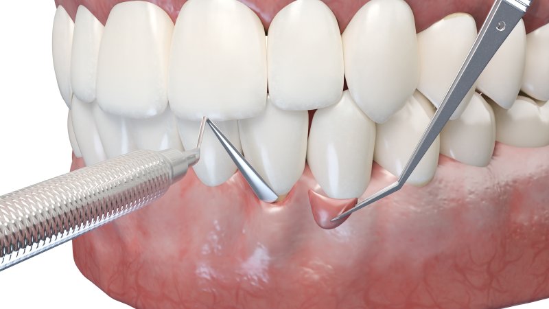 A 3D illustration of a gum graft surgery