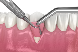 a 3D illustration demonstrating a gum tissue graft